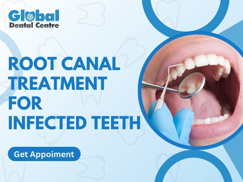 A close-up image of a dentist performing a root canal treatment on an infected tooth, with the text "Root Canal Treatment for Infected Teeth" from Global Dental Centre.