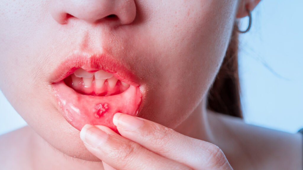 A close-up of a person holding their lower lip with their fingers, revealing a painful looking canker sore on the inside of the mouth.
