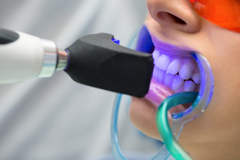 Close-up of a person's teeth being treated with a dental laser whitening tool. The teeth are exposed to blue light, and the person is wearing protective red glasses.