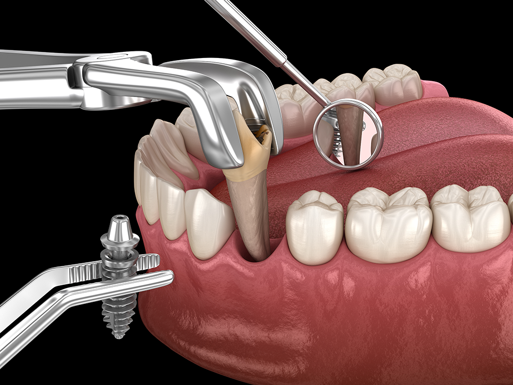 A dental procedure illustration showing a tooth extraction with a dental implant being inserted into the socket.