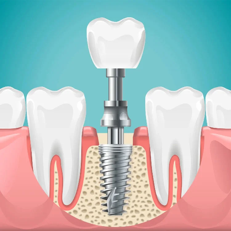 A detailed illustration of a dental implant showing the titanium post inserted into the jawbone with a dental crown on top.
