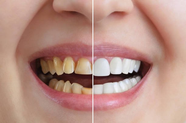 Before and after comparison of teeth whitening. On the left, the teeth appear yellowed, and on the right, the teeth are bright white.
