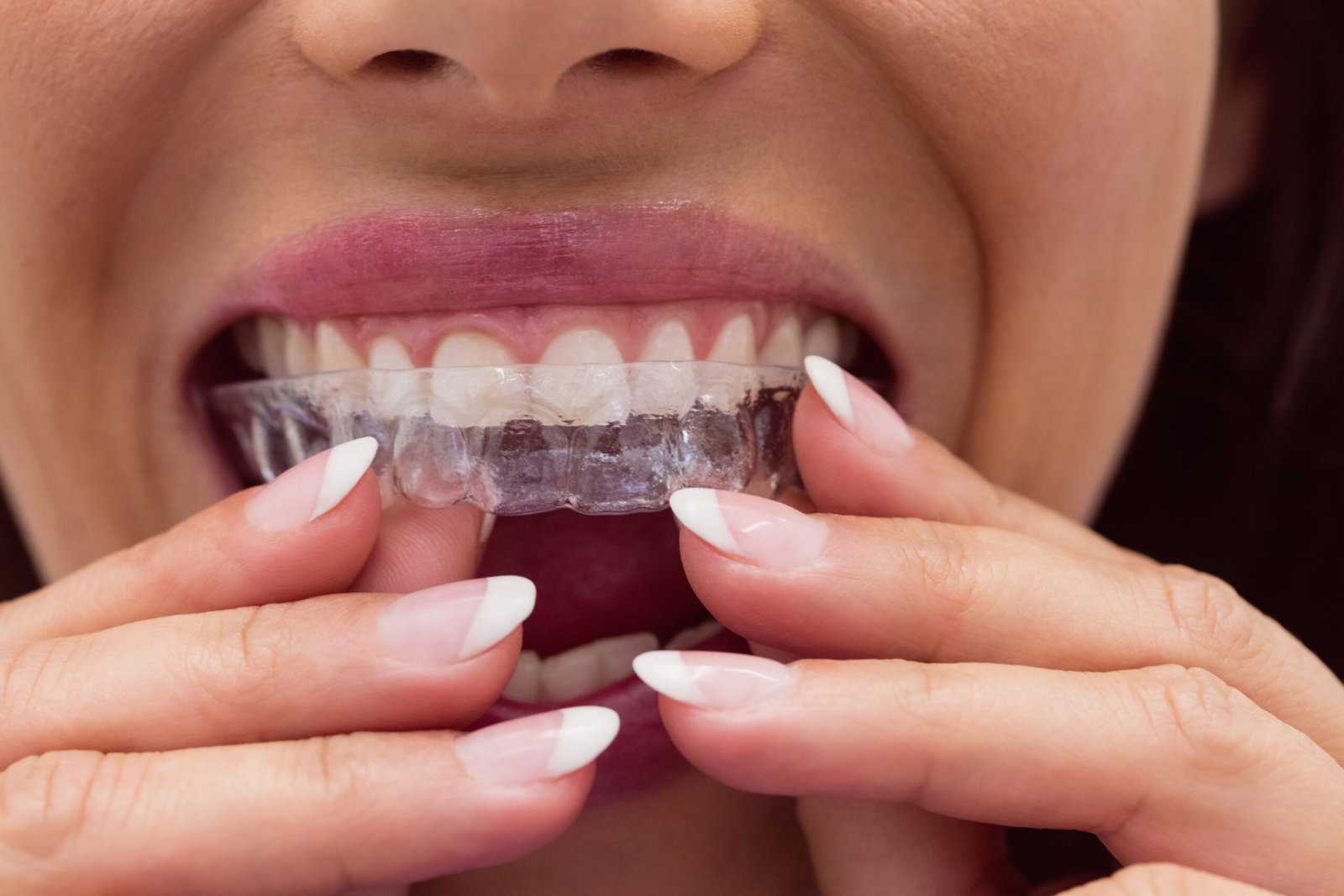A close-up image of a person wearing clear aligners while holding them with both hands, showing well-manicured nails and white teeth.